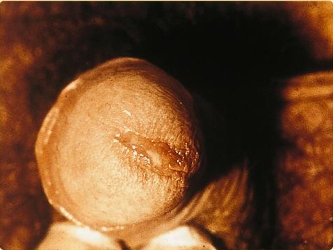 trieu-chung-chlamydia-trachomatis