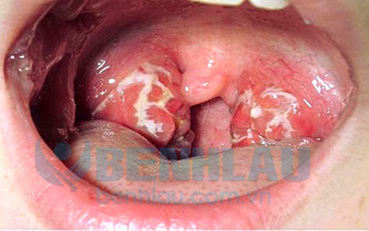 Hình ảnh bệnh lậu ở miệng khi nhiễm lậu cầu khuẩn